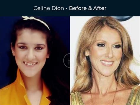 celine dion fake teeth|celine dion teeth.